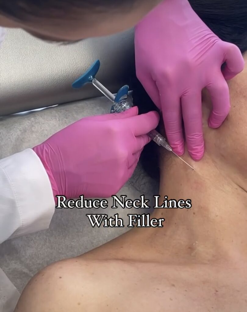 Filler-to-Reduce-Neck-lines-Hermosa-Beach-Medical-Spa