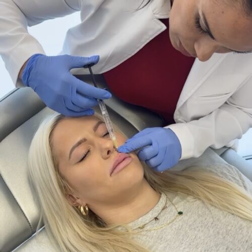 Lip Filler Manhattan Beach