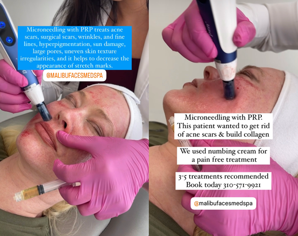 Microneedling-with-PRP-MF-Hermosa-Beach